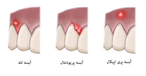 انواع آبسه شدن دندان